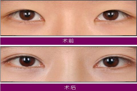 大連注射玻尿酸哪家醫(yī)院技術(shù)好，效果持久？