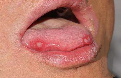 2023六安玻尿酸填充眼角皺紋專家前10位上榜名單(趙遵江、李成虎、夏利娟千萬別錯過！)