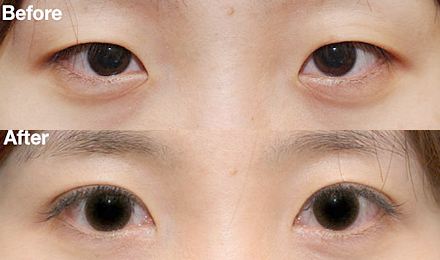 2023深圳黃金微針去除口周紋醫(yī)生綜合實(shí)力排行榜(鄭瑜璠、吳曉玲、劉彤大勢醫(yī)美重磅來襲)