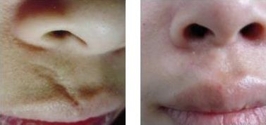 常州墊鼻梁哪家醫(yī)院好？專(zhuān)家推薦常州最受歡迎的鼻梁整形醫(yī)院