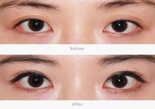 深圳哪家專(zhuān)業(yè)去黑眼圈機(jī)構(gòu)靠譜？