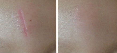 鄭州哪家醫(yī)院激光做的好？找尋專業(yè)！領(lǐng)先的鄭州醫(yī)院激光治療推薦