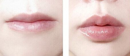 佛山做鼻子手術(shù)哪家醫(yī)院靠譜？