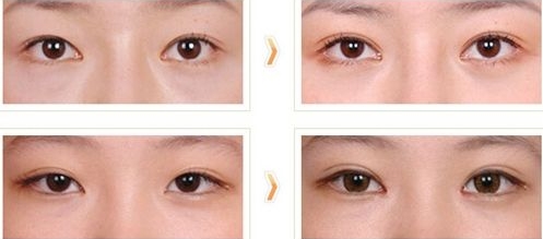 2023福州激光修復(fù)下眼皮皺紋權(quán)威專家榜單前十(黃劍媚、魏珊、周亞寬實(shí)力太驚艷！)