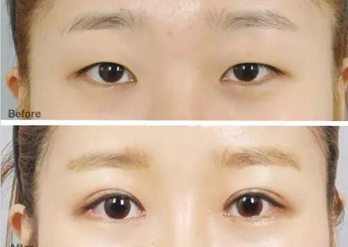 成都眼科醫(yī)院眼睛縫針技術(shù)如何？排名靠前的醫(yī)院有哪些？