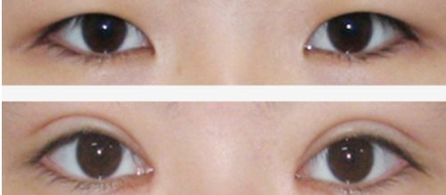 上海祛痘坑的醫(yī)院哪家好？讓你遠(yuǎn)離痘痘困擾的專業(yè)醫(yī)院有哪些？