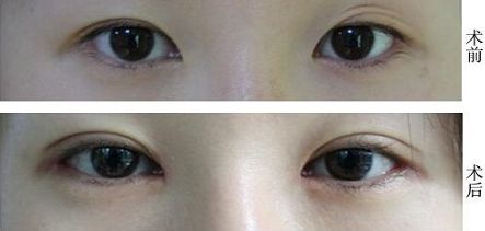 福州抽脂大腿哪家醫(yī)院好？挑選福州最靠譜的抽脂醫(yī)院有哪些？