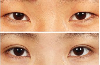 南寧去痘坑哪家醫(yī)院好？揭秘南寧市治療痘坑的頂尖專家團(tuán)隊(duì)！