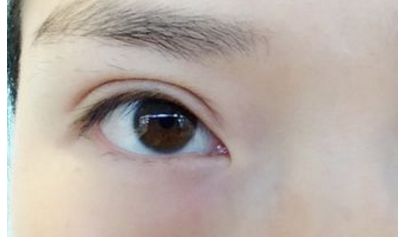 南昌祛痘哪家醫(yī)院口碑好，效果最佳？