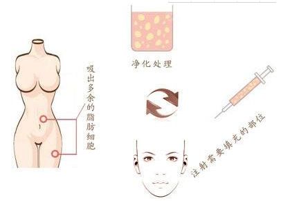 廣州燒傷疤痕治療哪家醫(yī)院效果好，選擇哪家醫(yī)院最靠譜？