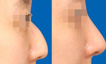 南京鼻綜合修復醫(yī)院哪家好？找準南京鼻部整形中心，為你解答！