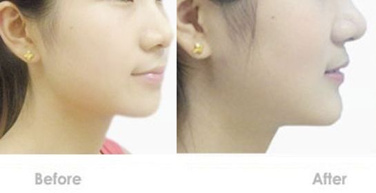 蘇州嘴唇改薄哪家醫(yī)院好？專業(yè)的整形醫(yī)院推薦