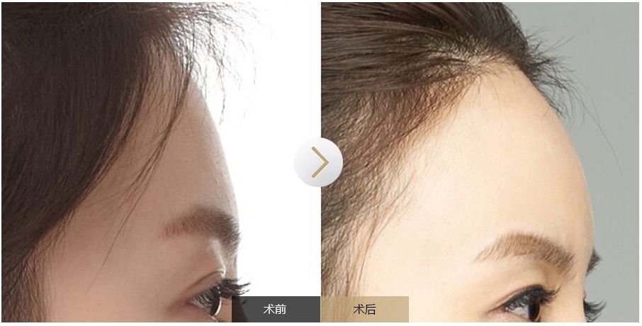 南寧點痣需求旺盛，哪家醫(yī)院是最受歡迎的？