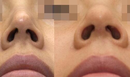 靳小雷雙眼皮修復(fù)手術(shù)的完美案例分享，期待您的見證