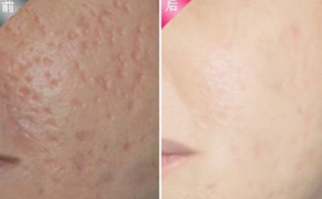 杭州做雙眼皮哪家好？2023年杭州雙眼皮整形醫(yī)院綜合排名指南拆解