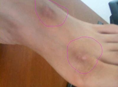 溫州哪家醫(yī)院做雙眼皮手術(shù)好？