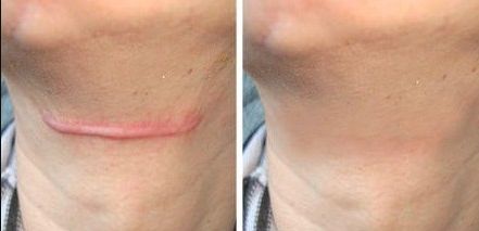 杭州市疤痕醫(yī)院哪家好？無痕祛疤，專業(yè)技術(shù)讓你恢復自信！