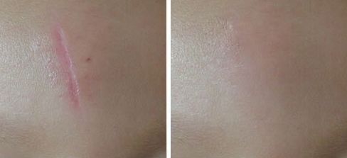 西安雙眼皮手術(shù)最佳推薦，哪家醫(yī)院技術(shù)好？