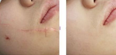 福州激光祛色斑哪家好？了解福州激光祛斑的優(yōu)秀機(jī)構(gòu)推薦！