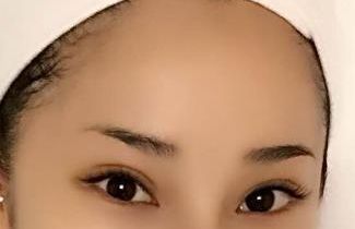 合肥哪家醫(yī)院臉部激光治療效果好，值得推薦？