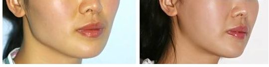 合肥假體隆胸哪家醫(yī)院好？術后效果如何？