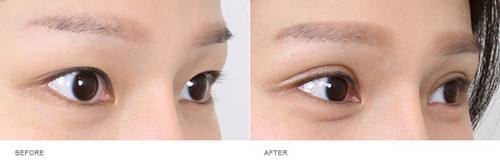 上海整容醫(yī)生推薦：讓您擁有完美鼻型，變身肋骨鼻！