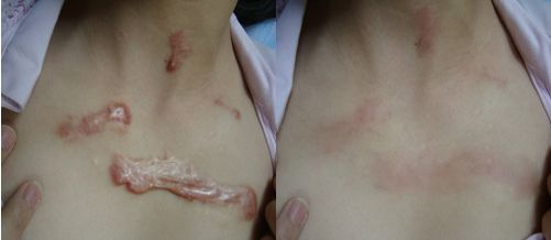 廣州市治療疤痕效果好的醫(yī)院有哪些？