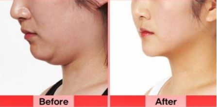 洛陽雙眼皮修復哪家好？挑選專業(yè)技術實力強的醫(yī)療機構