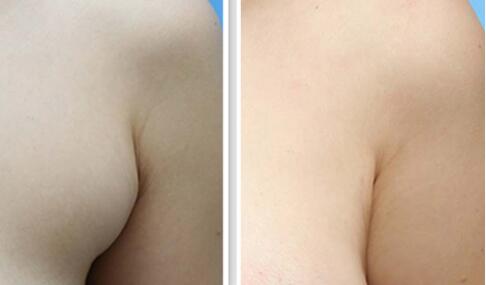 深圳北大何君君墊下巴案例分享，細(xì)節(jié)透露驚艷效果