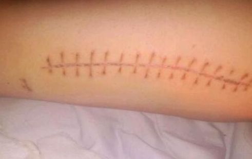 北京哪家醫(yī)院的隆胸假體效果好且價格合理