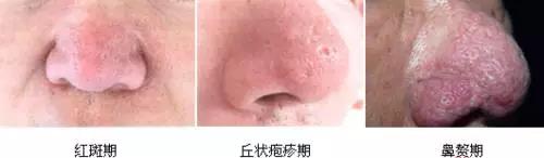 解密楊杰雙眼皮修復(fù)失敗案例圖，讓你心中的期望成為現(xiàn)實！