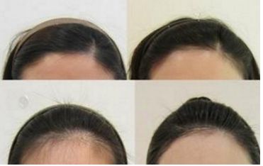 哈爾濱皮秒手術(shù)哪家醫(yī)院好？全面評測哈爾濱皮秒醫(yī)院排名