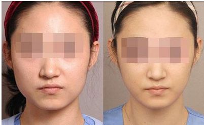 河南去胎記哪家醫(yī)院好？解析最適合您的整形醫(yī)院