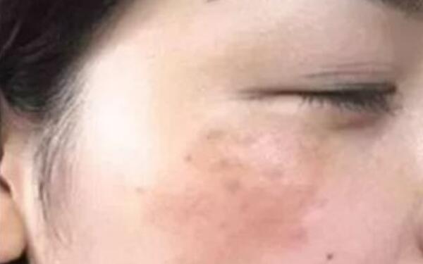 武漢協(xié)和醫(yī)院醫(yī)生鐘愛(ài)梅，精湛鼻子整形案例揭秘