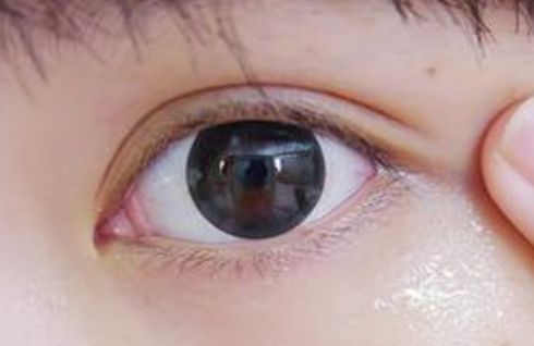 山東割眼袋哪家醫(yī)院好？眼袋手術(shù)山東醫(yī)院哪家專業(yè)靠譜？