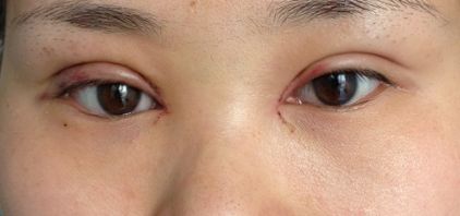 沈陽哪家醫(yī)院疤痕手術(shù)效果好？