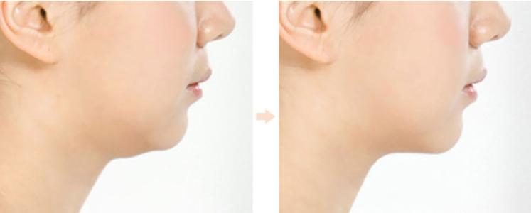 2023深圳面部填充面部皺紋專家前十名排行(曹琛、符國興、雋洪艷這些醫(yī)生權(quán)威有實力，值得信賴)