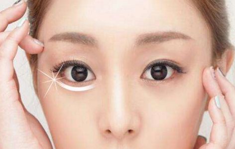 蘇州失敗雙眼皮修復(fù)哪家專業(yè)靠譜？