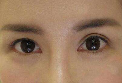 2023綿陽祛眼周紋打針強榜top10強的專家(童志洲、周雪、陳楊愛美人士強烈推薦！)