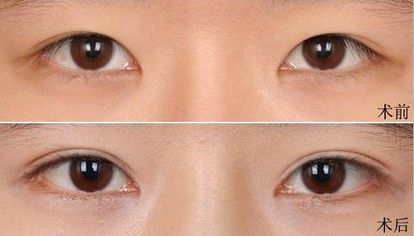 大連假體隆鼻哪家醫(yī)院好？打造完美鼻型，這家醫(yī)院是最佳選擇！