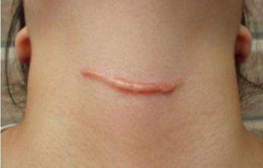 衡陽去痘坑哪家醫(yī)院好？-衡陽市專業(yè)祛痘修復(fù)醫(yī)院排行榜