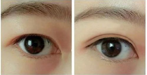 揭秘！哈爾濱哪家醫(yī)院的隆鼻手術(shù)效果最好推薦