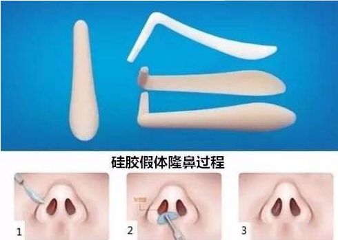 北京哪家醫(yī)院祛除眼袋效果最好？