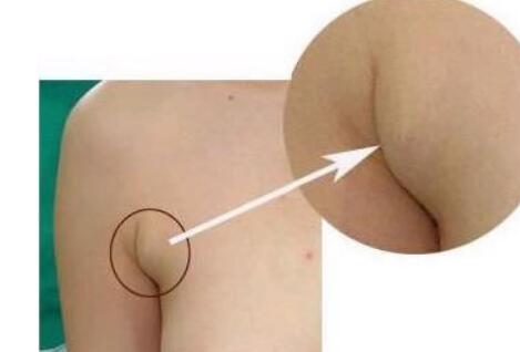 張誠教授為您的雙眼皮修復(fù)提供完美解決方案！成功案例分享，糾正雙眼皮失敗的救星~