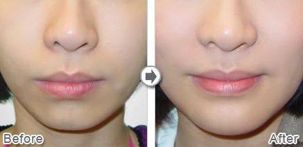 武漢熱瑪吉技術(shù)治療最好的醫(yī)院是哪家？