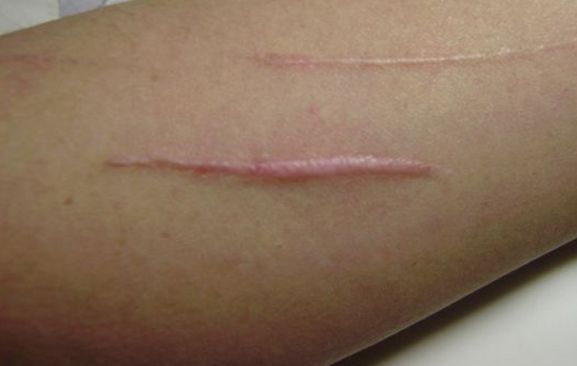 深圳哪家醫(yī)院的取膨體效果最好？