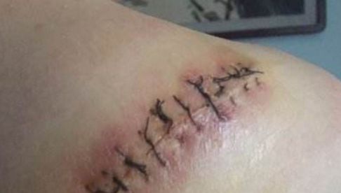 信陽哪家醫(yī)院祛痘效果好，專家推薦去哪家醫(yī)院治療痘痘？