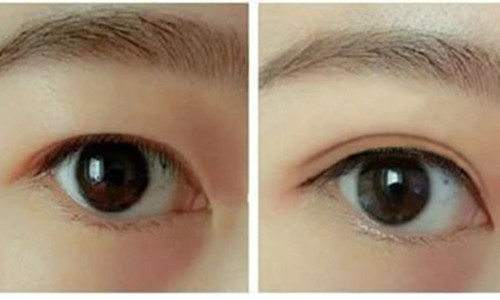 2023寧波拉皮去除眼睛細(xì)紋前10醫(yī)生排名榜(羅遠(yuǎn)洪、李公昌、李公昌絕絕子)