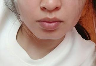 2023溫州疤痕微創(chuàng)手術(shù)正規(guī)專家前10位(蔡東亮、張波、王津評價看是網(wǎng)紅收費也不坑人)