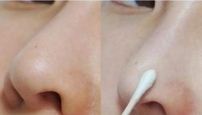 重慶華美整形美容醫(yī)院韋志遠疤痕修復效果體驗分享